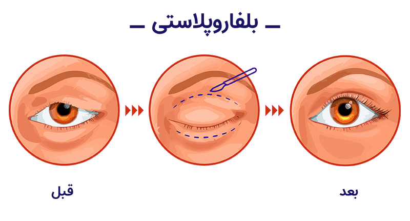 Blepharoplasty