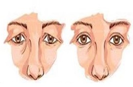 Blepharoplasty